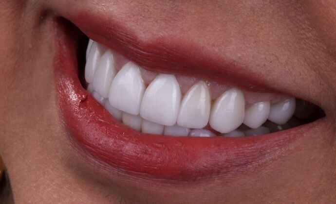 Smile Makeover & Veneers: Delia - After