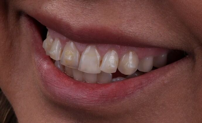 Smile Makeover & Veneers: Delia - Before
