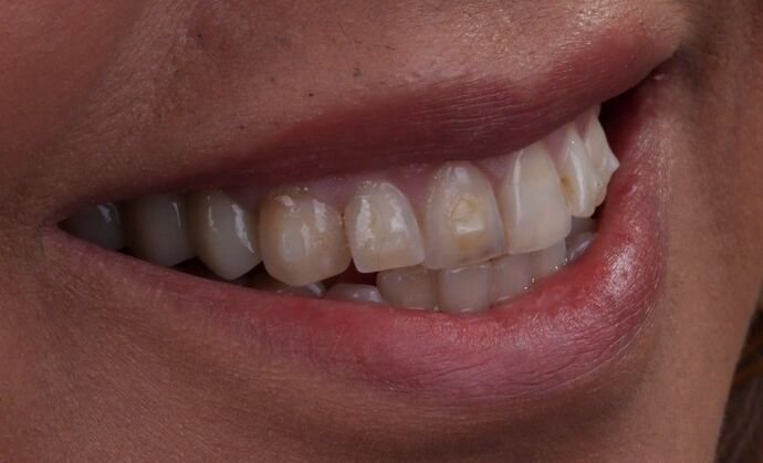 Smile Makeover & Veneers: Delia - Before
