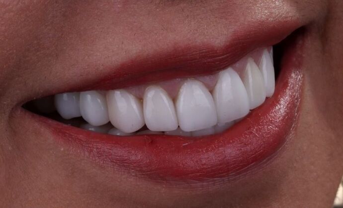 Smile Makeover & Veneers: Delia - After