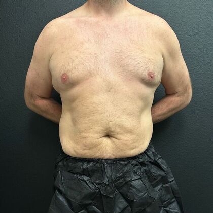 Male Body Contouring: Case 1 - Before