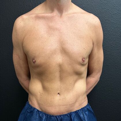 Male Body Contouring: Case 1 - After
