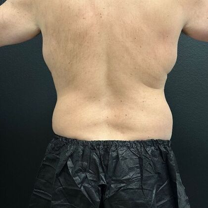 Male Body Contouring: Case 1 - Before