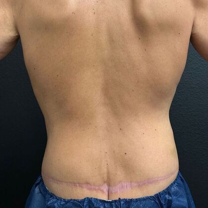 Male Body Contouring: Case 1 - After