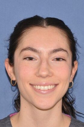 Rhinoplasty: Bump and a crooked nose - Before