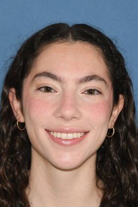 Rhinoplasty: Bump and a crooked nose - After