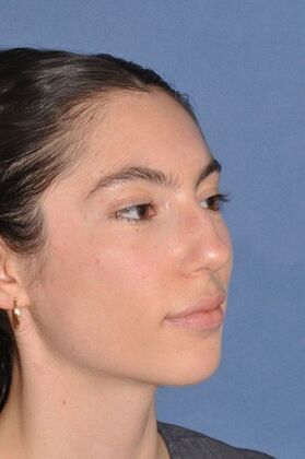 Rhinoplasty: Bump and a crooked nose - Before