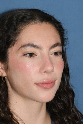 Rhinoplasty: Bump and a crooked nose - After