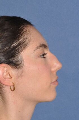 Rhinoplasty: Bump and a crooked nose - Before