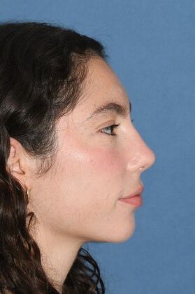 Rhinoplasty: Bump and a crooked nose - After