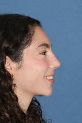 Rhinoplasty: Bump and a crooked nose - After