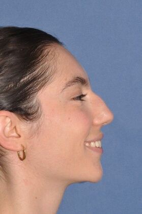 Rhinoplasty: Bump and a crooked nose - Before