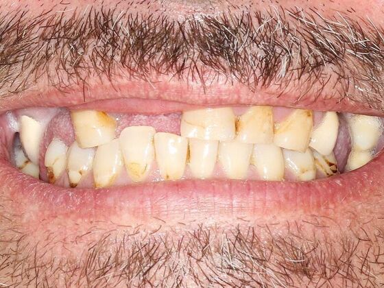 Smile Makeover Smile Transformation 3 - Before