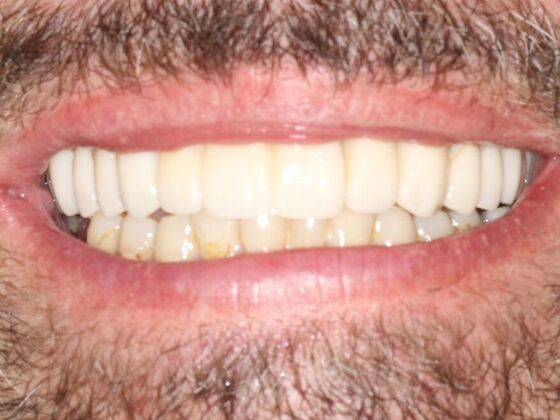 Smile Makeover Smile Transformation 3 - After