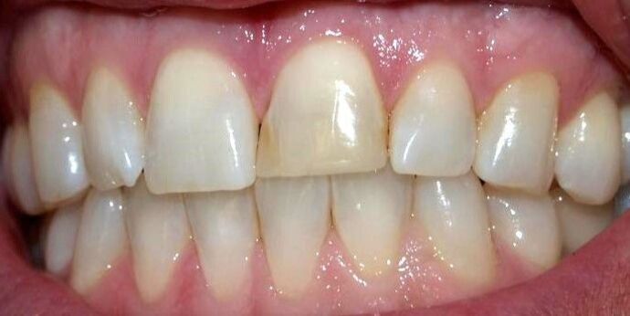 Porcelain Veneers Case 3 - Before