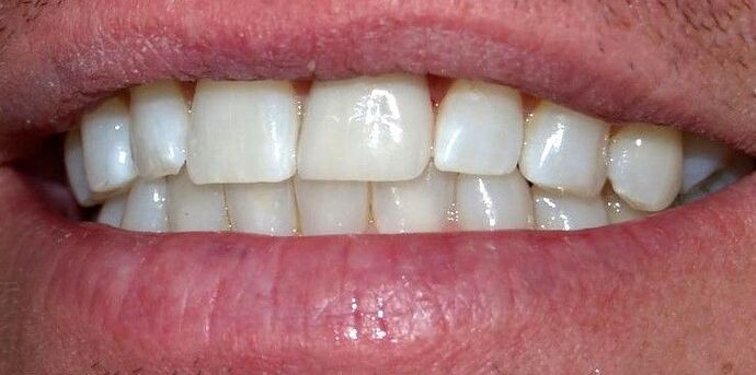 Porcelain Veneers Case 3 - After