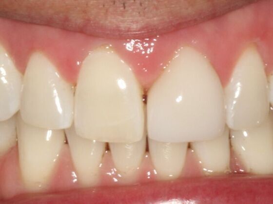 Porcelain Veneers Case 4 - Before
