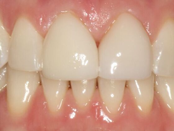 Porcelain Veneers Case 4 - After