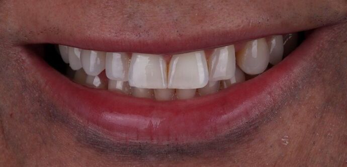 Smile Makeover & Veneers: Markus - Before