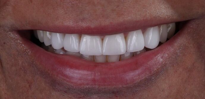 Smile Makeover & Veneers: Markus - After