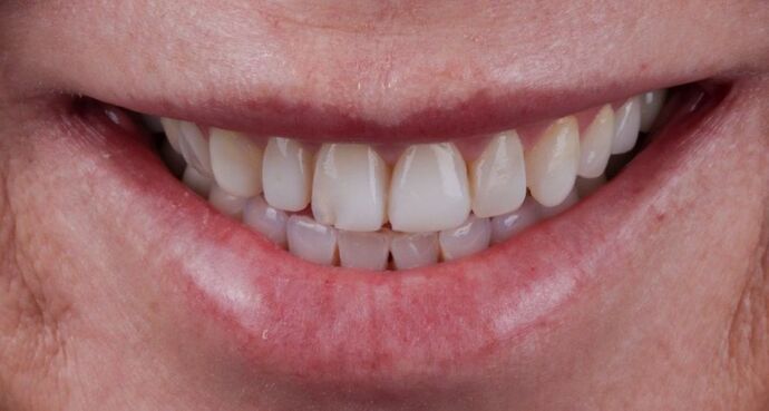 Smile Makeover & Veneers: Elena - Before