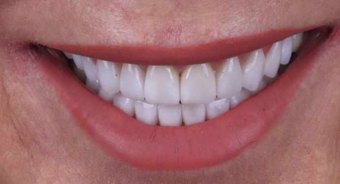 Smile Makeover & Veneers: Elena - After