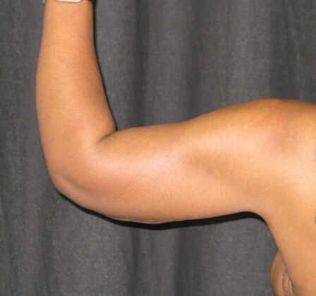 Brachioplasty (Arm Lift): Case 6 - After