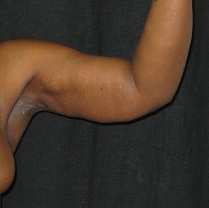 Brachioplasty (Arm Lift): Case 6 - After