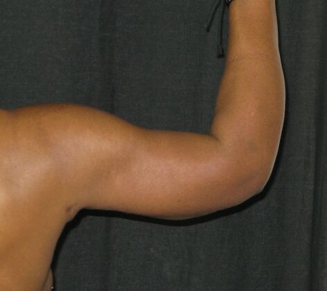 Brachioplasty (Arm Lift): Case 6 - After