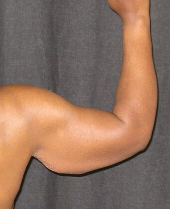 Brachioplasty (Arm Lift): Case 6 - Before
