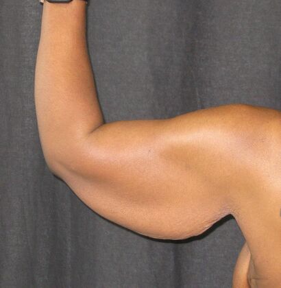 Brachioplasty (Arm Lift): Case 6 - Before