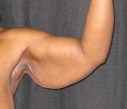 Brachioplasty (Arm Lift): Case 6 - Before