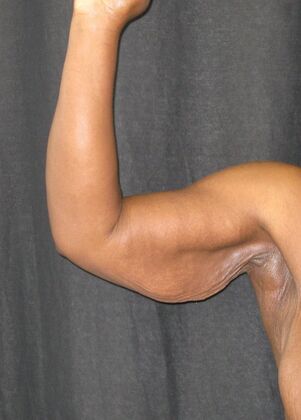 Brachioplasty (Arm Lift) Case 6 - Before