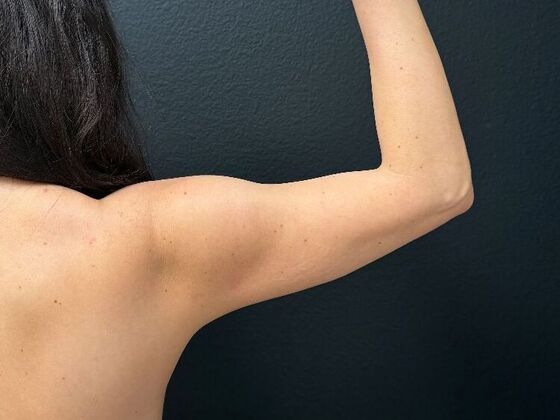 Liposuction Case 1 - Before