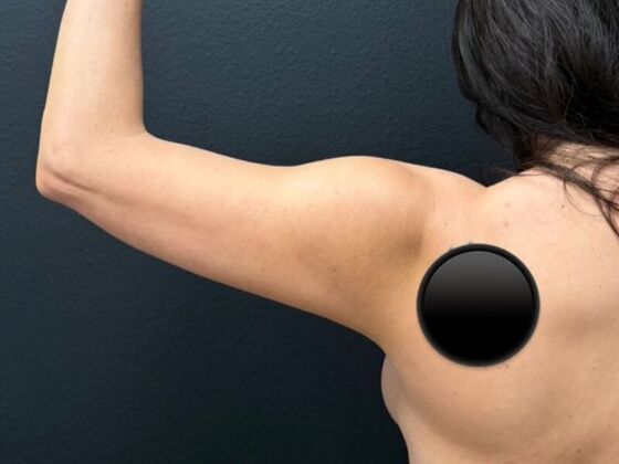 Liposuction: Case 1 - Before