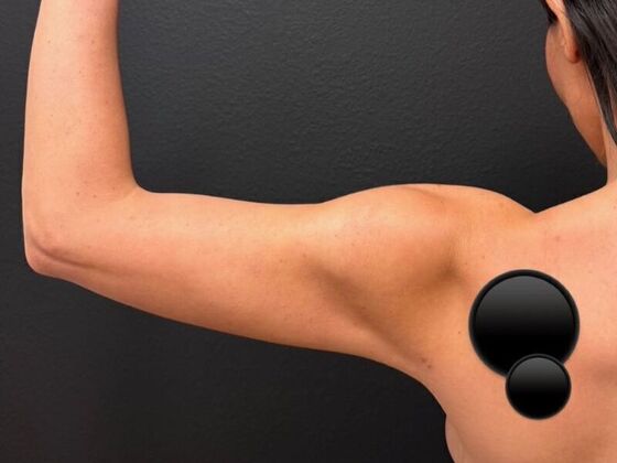 Liposuction: Case 1 - After