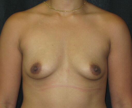 Breast Augmentation Case 16 - Before