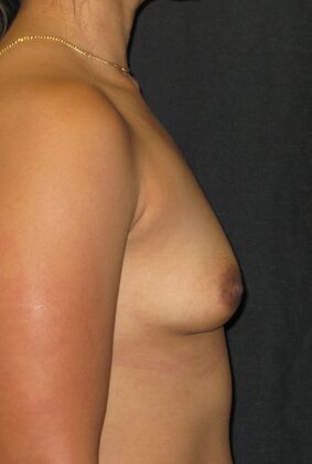 Breast Augmentation: Case 16 - Before
