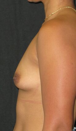 Breast Augmentation: Case 16 - Before