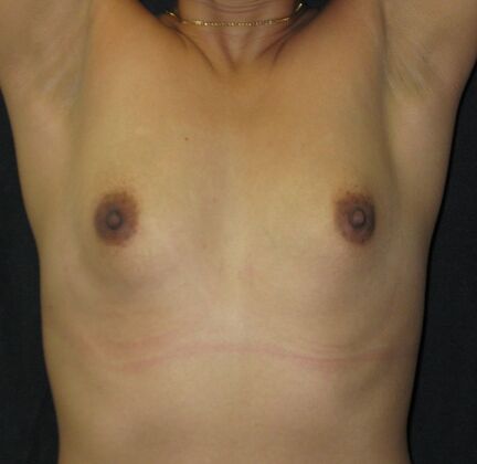 Breast Augmentation: Case 16 - Before