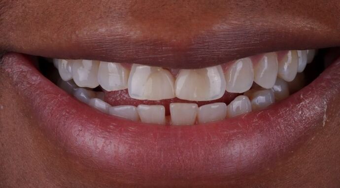 Smile Makeover & Veneers: Maya - Before