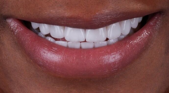Smile Makeover & Veneers: Maya - After