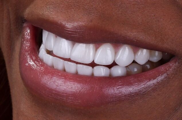 Smile Makeover & Veneers: Maya - After