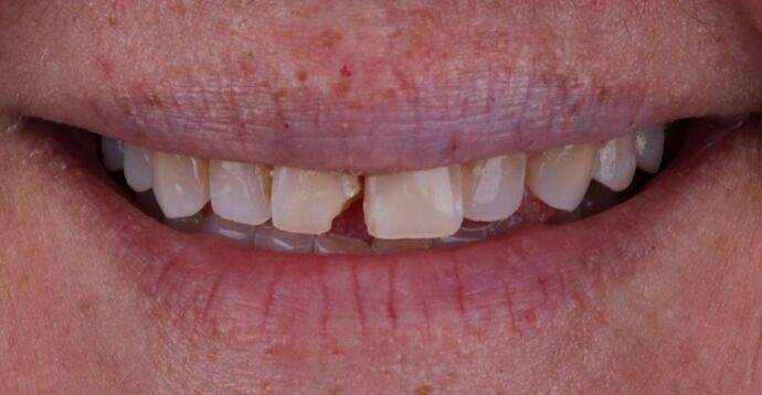Smile Makeover & Veneers: Desmond - Before