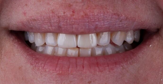Smile Makeover & Veneers: Desmond - After