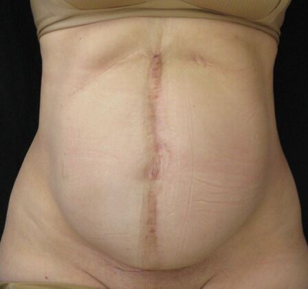 Fleur-de-Lys Abdominoplasty after massive weight loss Case 1 - Before
