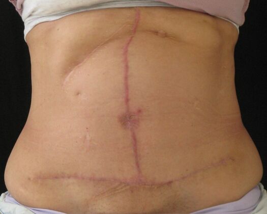 Fleur-de-Lys Abdominoplasty after massive weight loss Case 1 - After