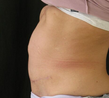 Fleur-de-Lys Abdominoplasty after massive weight loss: Case 1 - After