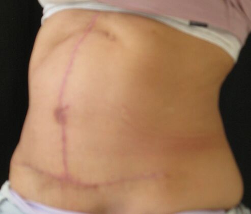 Fleur-de-Lys Abdominoplasty after massive weight loss: Case 1 - After