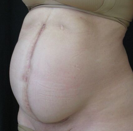 Fleur-de-Lys Abdominoplasty after massive weight loss: Case 1 - Before